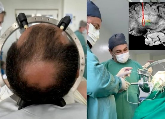 Microchip cerebral para tratamento de TOC é inserido pela 1ª vez em SC